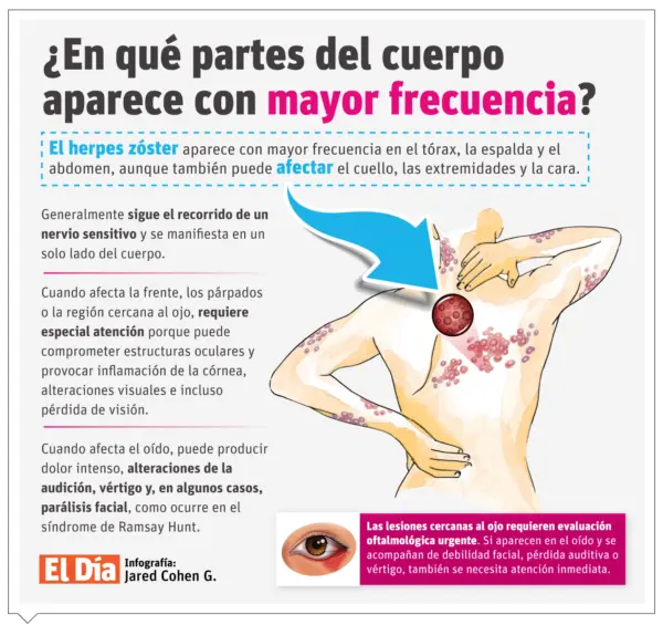 Info Herpes zóster