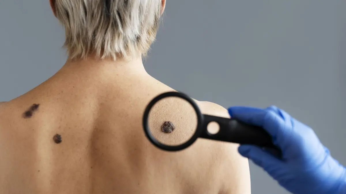 Dermatólogos advierten que remedios caseros para verrugas en redes sociales pueden causar quemaduras y cicatrices Dermatólogos advierten que remedios caseros para verrugas en redes sociales pueden causar quemaduras y cicatrices